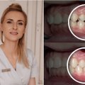 Ištiesinti dantis galima paprasčiau ir greičiau nei manėte: odontologė pasakė, ką svarbu žinoti