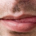 Kodėl sutinsta liežuvis? Gydytojai įvardijo keletą galimų priežasčių