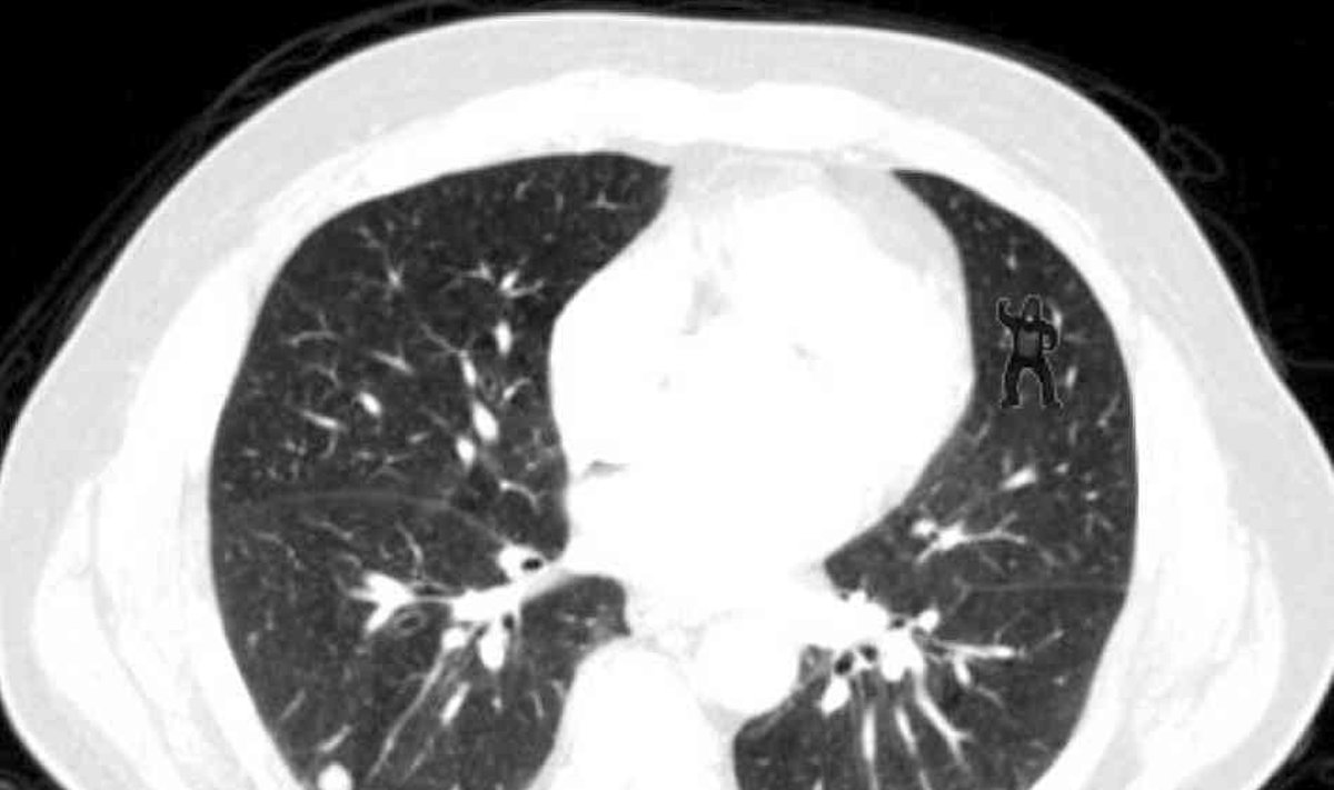 Plaučių tomografijos vaizdas su gorila (tyrimo organizatorių nuotr.)
