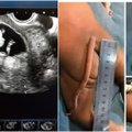 Kūdikis su uodega – ne fotomontažas: internautai pasipiktino sužinoję, kad medikai ją nupjauna neatsiklausę šeimininko