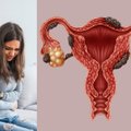 Apie endometriozę turi žinoti kiekviena: gerai besijaučiančios gali neįtarti problemos, tačiau pasekmės – skaudžios