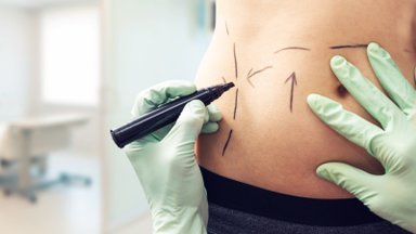 Plastikos chirurgas: šiais laikais moterys drąsiai sako, ko ir kokio dydžio nori