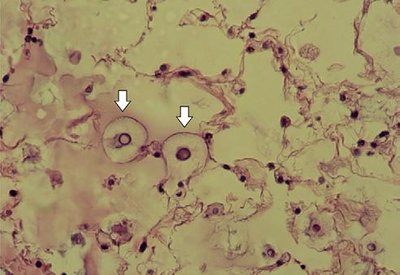 Cryptococcus gattii sukelia plaučių ir smegenų ligas. Scanpix/Wikipedia/Shutterstock/Claudia Del Fava nuotr.