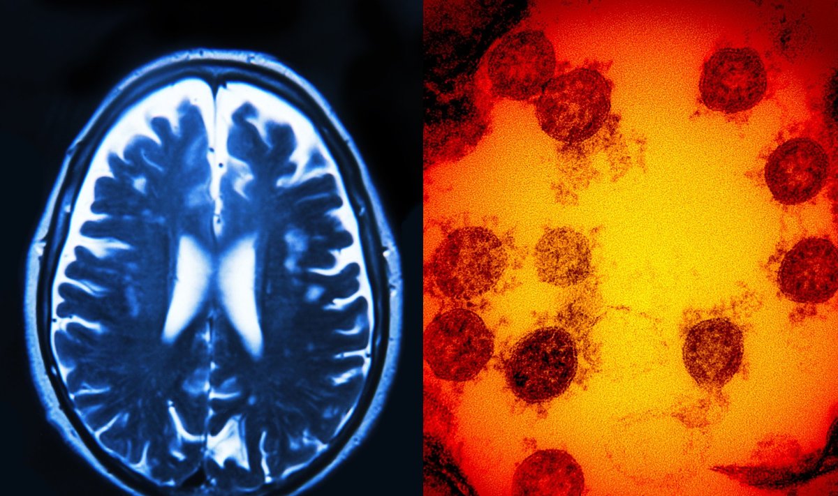 COVID-19 poveikis smegenims. Shutterstock/Scanpix nuotr.