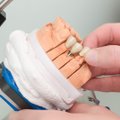 Pristatyta dantų implantavimo naujovė – unikalus išradimas, taupantis pinigus ir laiką
