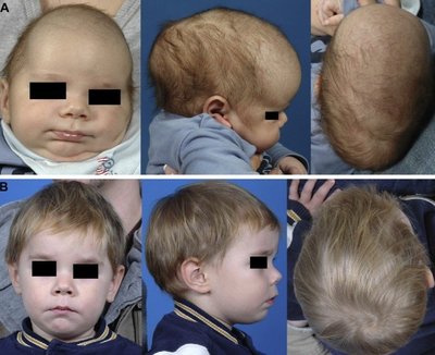 Kaukolės deformacijos (Journal of Cranio-Maxillo-Facial Surgery nuotr.)