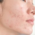 Spuogais nusėtas veidas: kosmetologė pasakė, kokios priemonės gali išgydyti šią bjaurią veido odos ligą