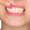 Periodontologė papasakojo, kaip dantenų kraujavimas gali lemti nėštumo komplikacijas