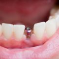 Didžiausi mitai, susiję su dantų implantais – ką reikėtų žinoti?