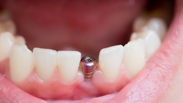 Po dantų implantavimo – nemalonus kvapas ir pūlingos išskyros iš nosies: paaiškino, kodėl taip nutinka