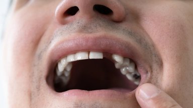 Šokiruojanti tiesa – daug lietuvių neturi savų dantų: odontologai patarė, kaip juos išsaugoti iki senatvės
