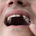 Prarastus dantis geriau atkurti nedelsiant: gydytojai papasakojo, kas gresia tai atidėliojantiems