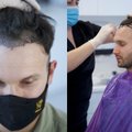 Vaidas Baumila parodė šukuoseną po plaukų transplantacijos: iškilusias problemas reikia spręsti