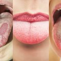 Liežuvis – organizmo veidrodis: sužinok savo sveikatos problemas