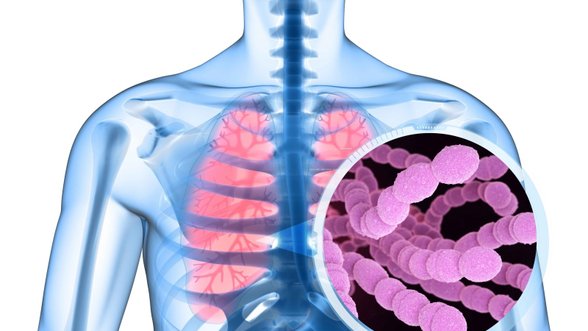 Daktaras – apie plaučių uždegimą, sinusitą ar net sepsį sukeliančią bakteriją: gali ilgai tūnoti be simptomų