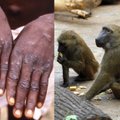 Didžiausią nerimą turėtų kelti ne beždžionių raupai: tai – tik pradžia, žmonijos tyko dar pavojingesnės ligos