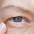 Gydytoja patarė, kas gali padėti atitolinti akių vokų užkritimo simptomų pasireiškimą ar padėti išvengti operacijos
