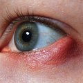 Šaltasis miežis – itin dažna akių liga: gydytoja paaiškino, kaip jis atsiranda ir kaip gydomas