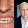 Odontologas įvardijo pagrindinę dantų netekimo priežastį: jos išvengti – labai paprasta
