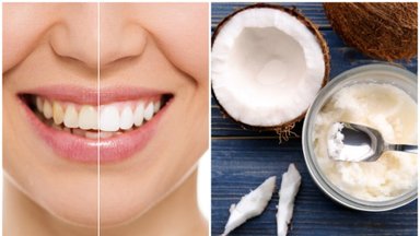 Atsakė, ar tikrai kokosų aliejus gali išbalinti dantis