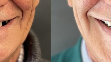 Unikalus metodas – dantų atstatymas ilgaisiais implantais