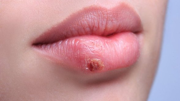 Lūpų pūslelinės galima ir išvengti: 3 būdai, kaip nuo jos apsisaugoti