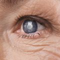 Lėtai besivystanti akių liga: kartais nepastebima iki vėlyvos stadijos, kai nuo aklumo gydymo nebėra