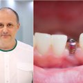 Valstybė tam skiria tūkstančius: ar galima vaikams implantuoti dantis?