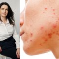 Gydytoja dermatologė Greta Valančienė apie dažną odos ligą: arba išmoksite ją valdyti, arba ji jums apkartins gyvenimą