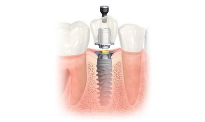 Danties implanto pavyzdys