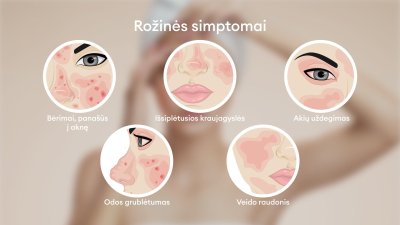 Rožinės simptomai