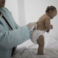 Patvirtino ryšį tarp Zikos viruso ir kūdikių apsigimimų