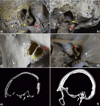 Ispanijoje aptikta 5300 metų amžiaus kaukolė tuo pačiu yra ir seniausios ausies operacijos įrodymas. S Díaz-Navarro et al. 2022, Scientific Reports. 