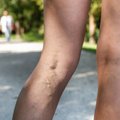 Liga, kuri kankina net pusę milijono lietuvių: pokyčiai ant jūsų kojų gali baigtis labai rimtomis komplikacijomis