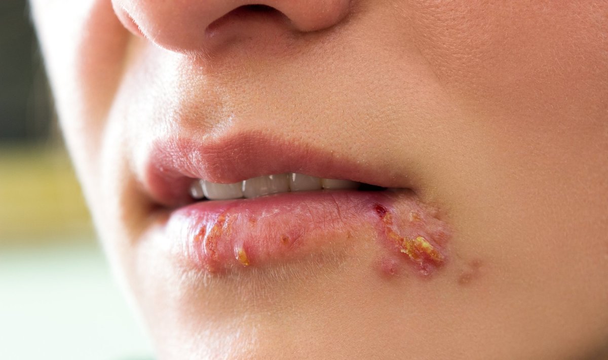 Lūpų pūslelinė – nemaloni liga, kurią sukelia herpes simplex virusas.