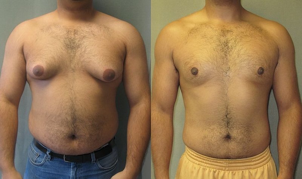 Vyrai kenčia dėl augančios krūtinės – ši liga vadinama ginekomastija