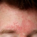 Uždegiminė odos liga, itin varginanti žiemos metu: išduoda paraudimai, pleiskanos ir niežulys