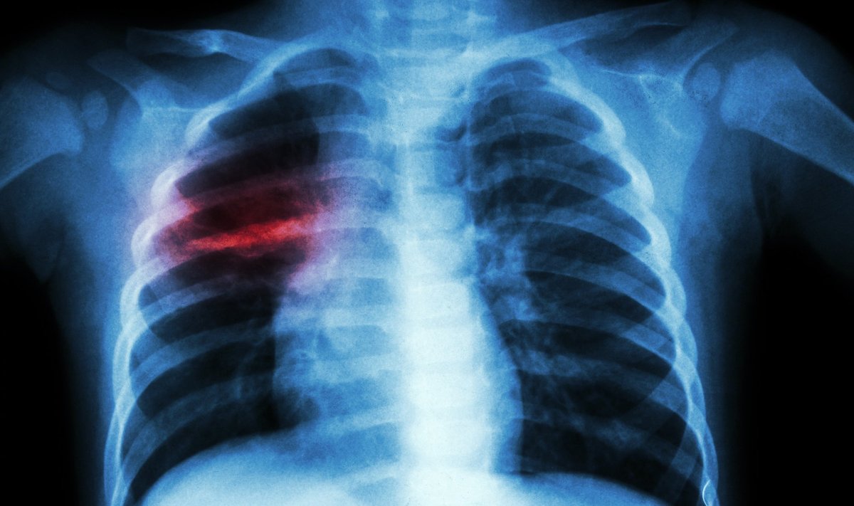 Tuberkuliozės židinys plaučiuose