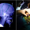 Elektrodus į žmogaus smegenis implantavę mokslininkai pasiekė stulbinantį rezultatą: dirbtinis intelektas pagerino protinę veiklą