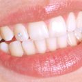 Ką dantys pasako apie jūsų charakterį