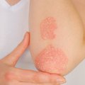 Neignoruokite šio odos bėrimo: dėl jo didėja kitų lėtinių ligų rizika