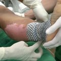 Brazilijoje bandomas nudegimų gydymo būdas tilapijų oda