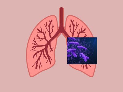 Plaučių tuberkuliozė
