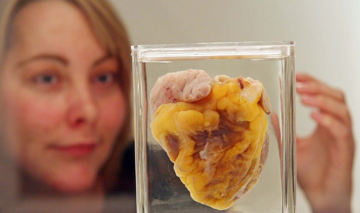 Praėjus 16 metų po transplantacijos, 38 metų sulaukusi J. Sutton aplankė savo širdį, eksponuojamą muziejuje. 