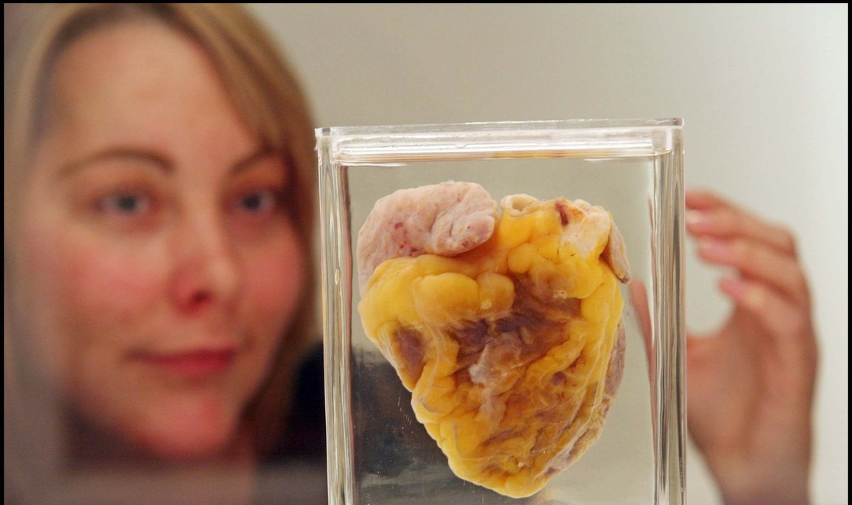 Praėjus 16 metų po transplantacijos, 38 metų sulaukusi J. Sutton aplankė savo širdį, eksponuojamą muziejuje.