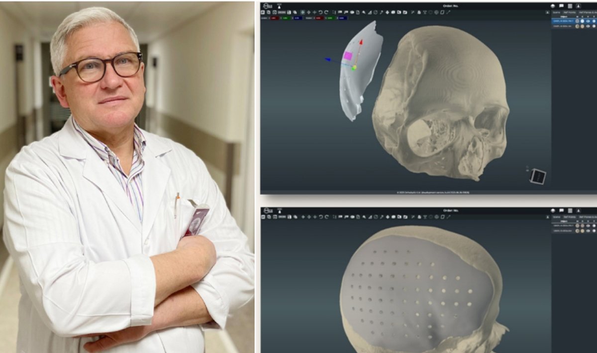 Gydytojas neurochirurgas Artūras Tamulis / Kranialinių implantų 3D modeliavimas kompiuteriu