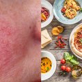 Dietistė išvardijo maisto produktus, kurių reikia atsisakyti, jei turite šią odos problemą