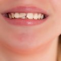 Odontologė įspėja, kokie veiksmai turi būti atliekami nuskilus dančiui ar jį praradus: kitu atveju padėti bus sunku