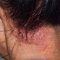 Pleiskanos ir niežulys gali išduoti uždegiminę odos ligą, kuri suaktyvėja šaltuoju metų laiku