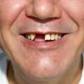 Tyrimas parodė, kad pusei Lietuvos gyventojų trūksta dantų